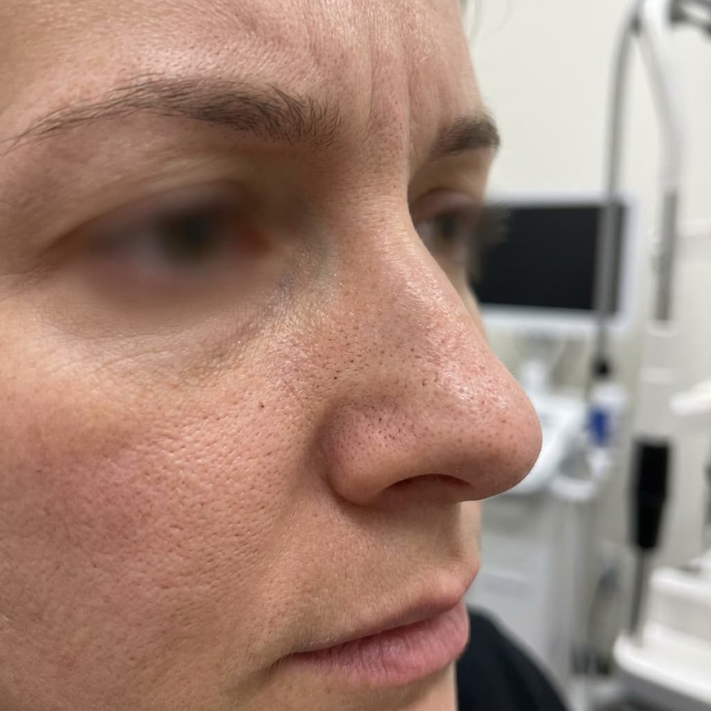 Hydrafacial before and after result